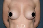 HR Plastic Surgery - Breast Enlargement patient after 1