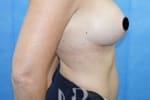 HR Plastic Surgery - Breast Enlargement patient after 11