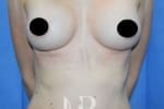 HR Plastic Surgery - Breast Enlargement patient after 12