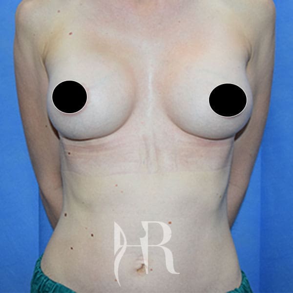 HR Plastic Surgery - Breast Enlargement patient after 12
