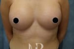HR Plastic Surgery - Breast Enlargement patient after 13