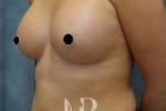 HR Plastic Surgery - Breast Enlargement patient after 14