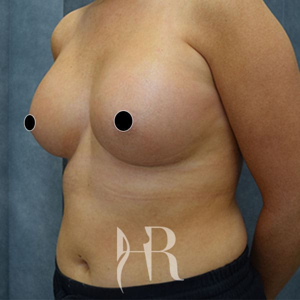 HR Plastic Surgery - Breast Enlargement patient after 14