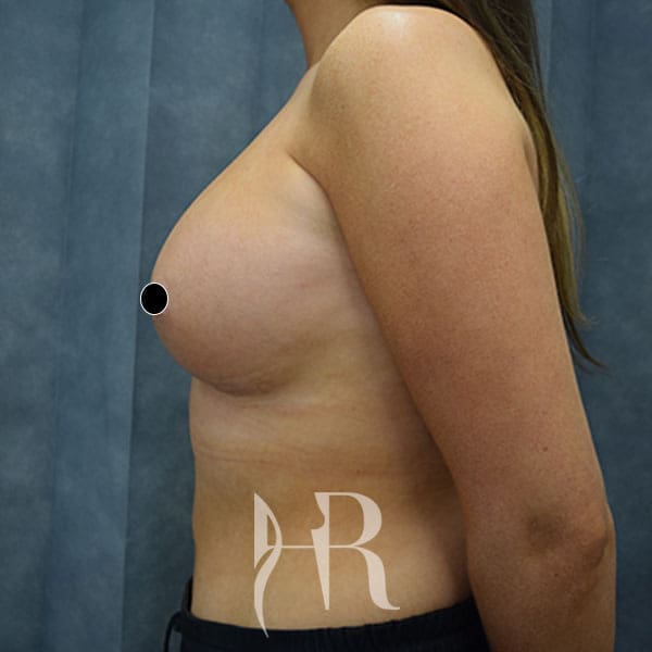 HR Plastic Surgery - Breast Enlargement patient after 15