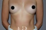 HR Plastic Surgery - Breast Enlargement patient after 4