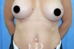 HR Plastic Surgery - Breast Enlargement patient after 9