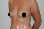 HR Plastic Surgery - Breast Enlargement patient before 2
