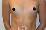 HR Plastic Surgery - Breast Enlargement patient before 4
