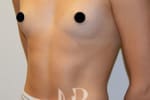 HR Plastic Surgery - Breast Enlargement patient before 5