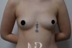 HR Plastic Surgery - Breast Enlargement patient before 6