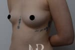 HR Plastic Surgery - Breast Enlargement patient before 7