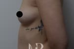 HR Plastic Surgery - Breast Enlargement patient before 8