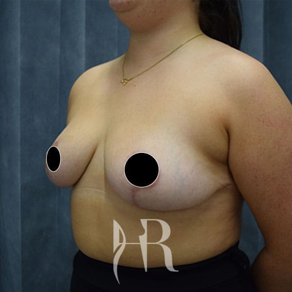 HR Plastic Surgery - Breast Reduction patient after 2