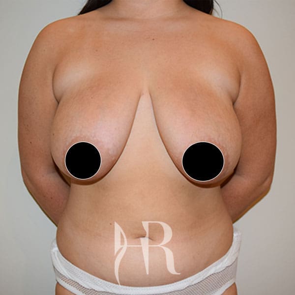 HR Plastic Surgery - Breast Reduction patient before 1