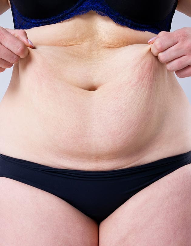 HR Plastic Sugery - Excess - loose abdominal skin Common Causes