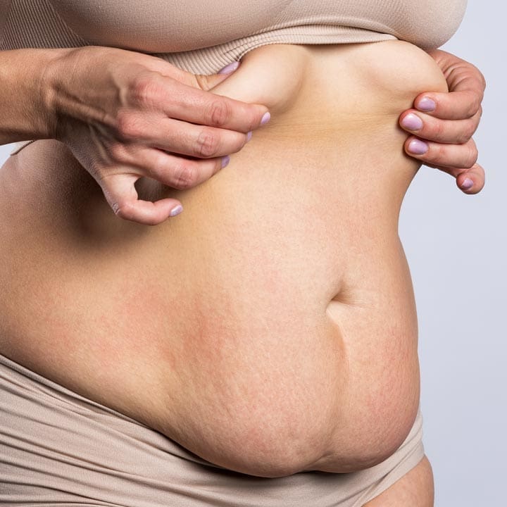 HR Plastic Sugery - Excess - loose abdominal skin What can i do