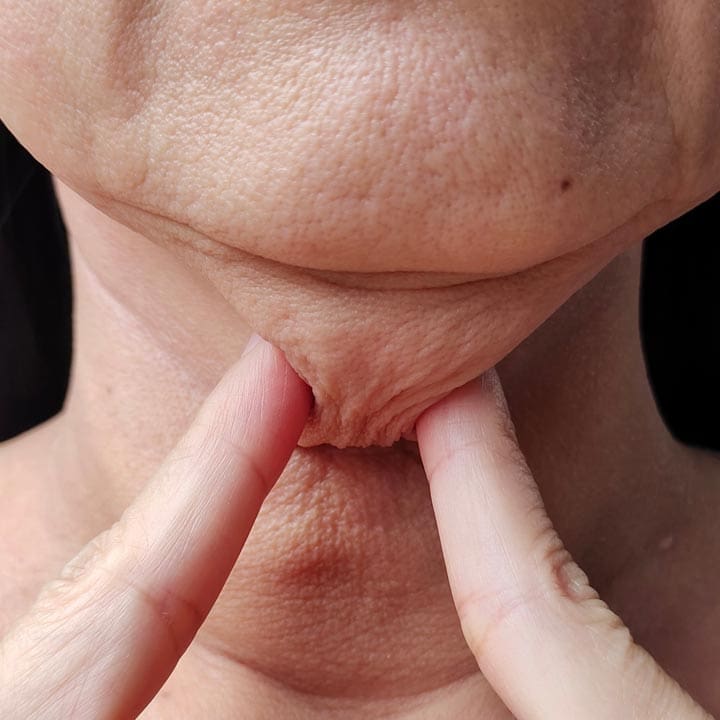 HR Plastic Sugery - Loose neck skin - full neck What Can I do