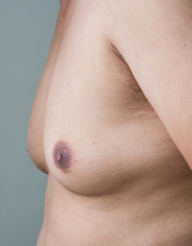 HR Plastic Sugery - Man boobs - Moobs What Can I do Common Causes