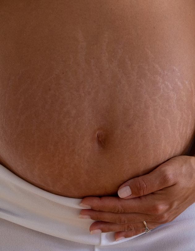 HR Plastic Sugery - Tummy stretch marks Common Causes