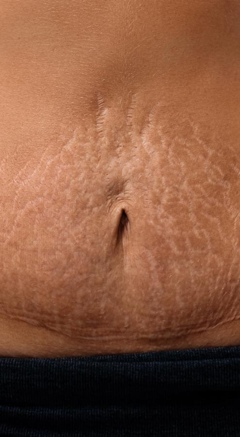 HR Plastic Sugery - Tummy stretch marks