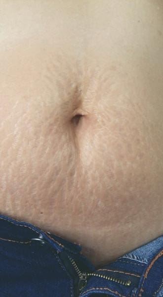 HR Plastic Sugery - Tummy stretch marks
