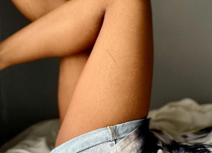HR Plastic Surgery - Thigh Lift What is