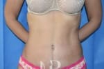 HR Plastic Surgery - Tummy Tuck patient after 3