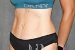 HR Plastic Surgery - Tummy Tuck patient after 12