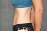 HR Plastic Surgery - Tummy Tuck patient after 13