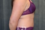 HR Plastic Surgery - Tummy Tuck patient after 15
