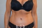 HR Plastic Surgery - Tummy Tuck patient after 16