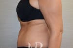 HR Plastic Surgery - Tummy Tuck patient after 18
