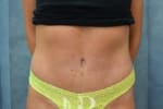 HR Plastic Surgery - Tummy Tuck patient after 19