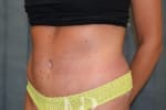 HR Plastic Surgery - Tummy Tuck patient after 20
