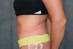 HR Plastic Surgery - Tummy Tuck patient after 21