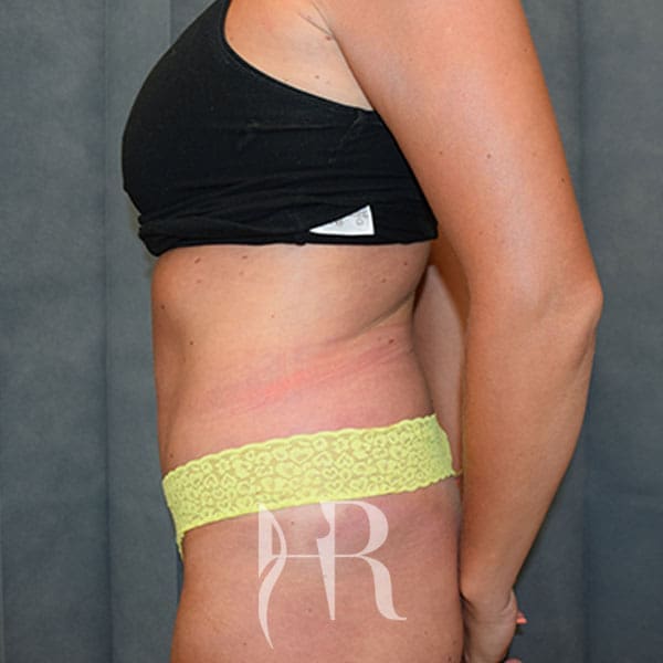 HR Plastic Surgery - Tummy Tuck patient after 21