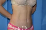 HR Plastic Surgery - Tummy Tuck patient after 4