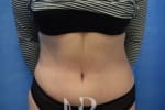 HR Plastic Surgery - Tummy Tuck patient after 22