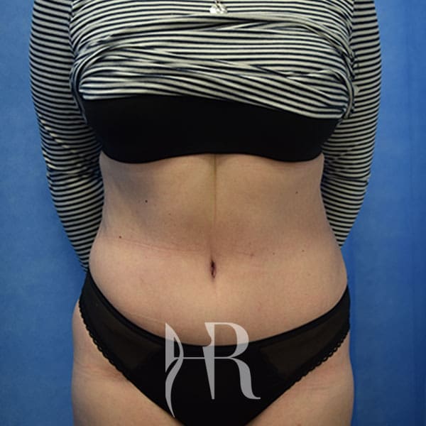 HR Plastic Surgery - Tummy Tuck patient after 22
