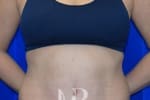 HR Plastic Surgery - Tummy Tuck patient after 23