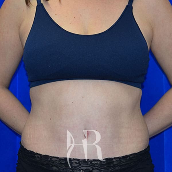 HR Plastic Surgery - Tummy Tuck patient after 23