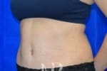 HR Plastic Surgery - Tummy Tuck patient after 24