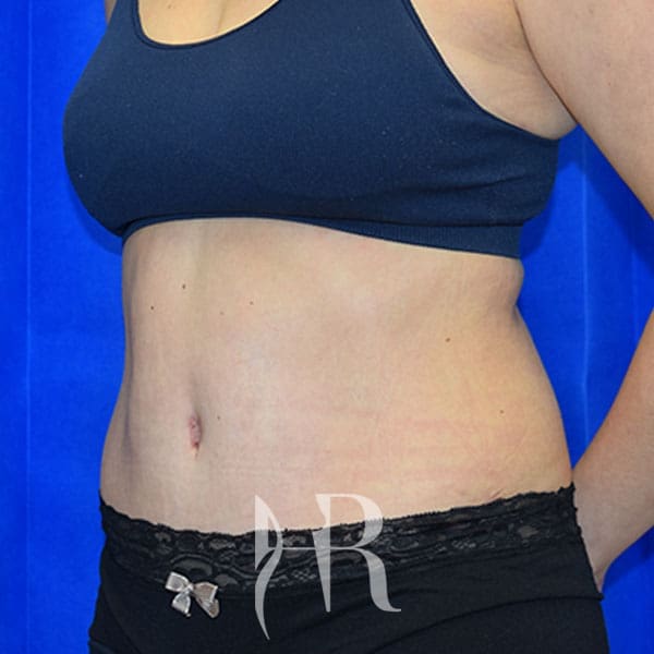 HR Plastic Surgery - Tummy Tuck patient after 24