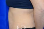 HR Plastic Surgery - Tummy Tuck patient after 25