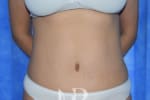 HR Plastic Surgery - Tummy Tuck patient after 26