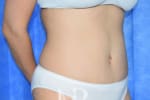 HR Plastic Surgery - Tummy Tuck patient after 27