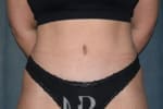 HR Plastic Surgery - Tummy Tuck patient after 6