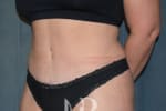 HR Plastic Surgery - Tummy Tuck patient after 7