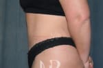 HR Plastic Surgery - Tummy Tuck patient after 8