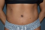 HR Plastic Surgery - Tummy Tuck patient after 9